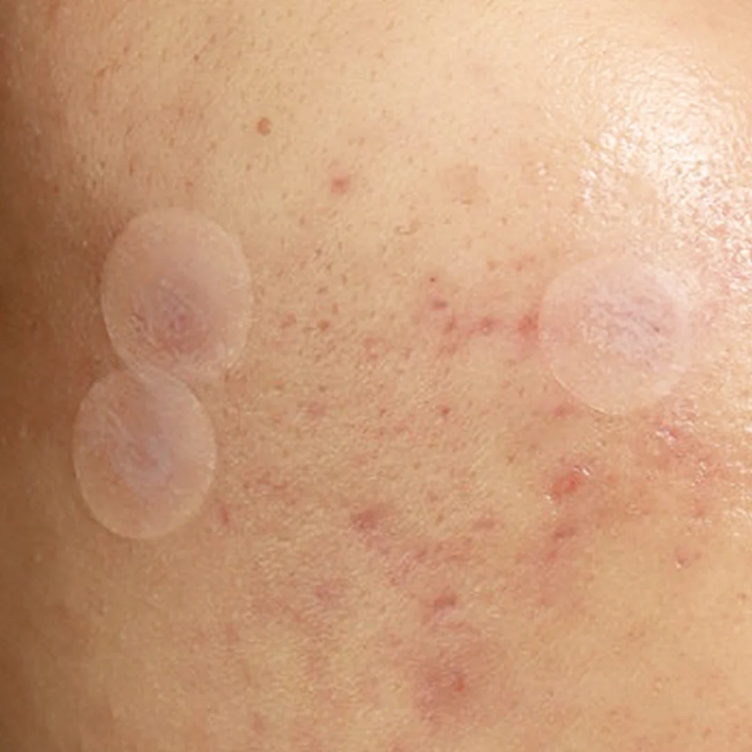 Patch Me Up Waterproof Pimple Patches - Image 7